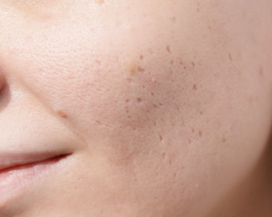 what is Ice Pick Scar and How to Remove It